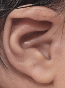 newborn ear deformities