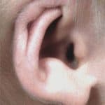 newborn ear deformities