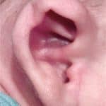 newborn ear deformities
