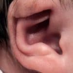 newborn ear deformities